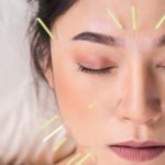 Facial Rejuvenation Acupuncture