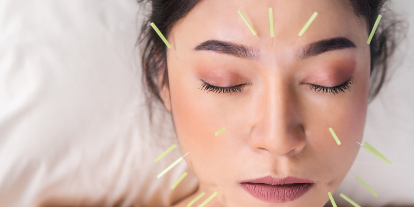 Facial Rejuvenation Acupuncture