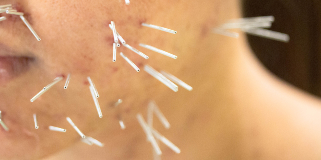 Facial Rejuvenation Acupuncture