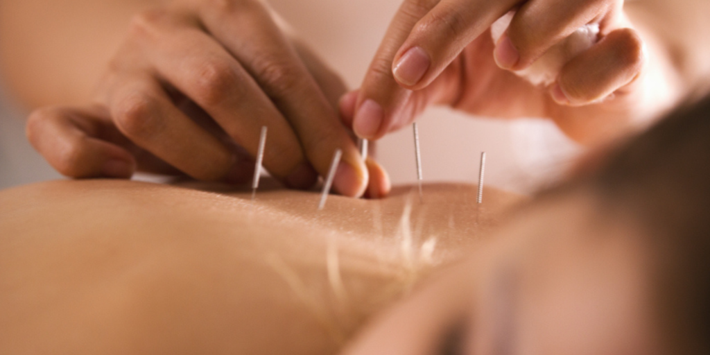 History Of Acupuncture: 5 Millennia of Healing