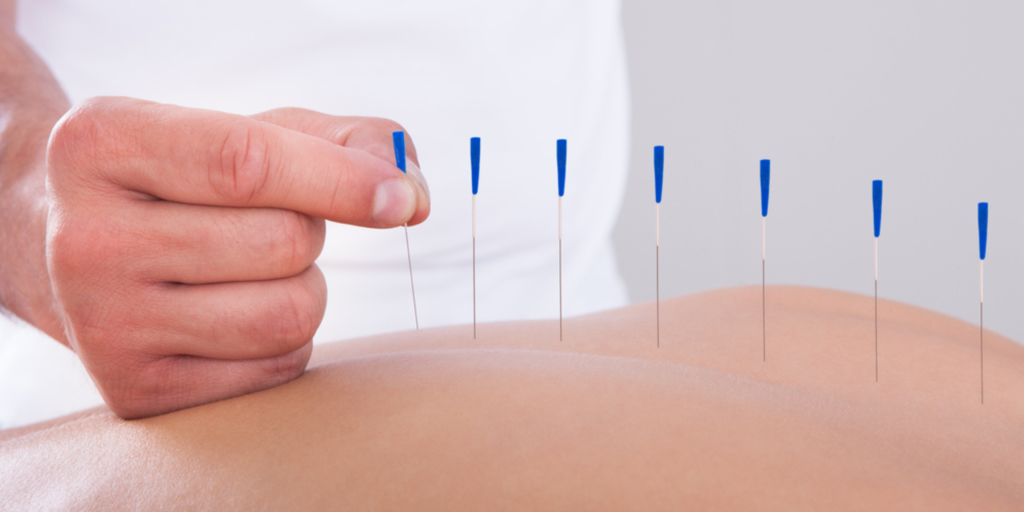 History Of Acupuncture: 5 Millennia of Healing