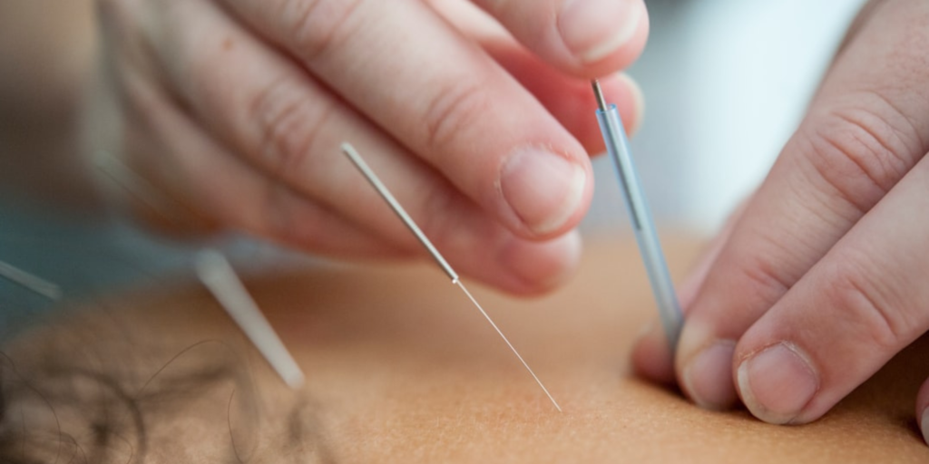 Acupuncture for Better Digestion